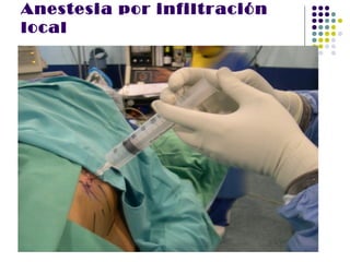 Anestesia por infiltración
local
 