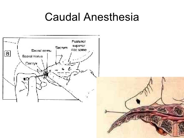 Anestesia caudal sb
