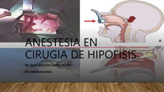 ANESTESIA EN
CIRUGIA DE HIPOFISIS
DR JESUS ANTONIO LOPEZ LAZARO
R3 ANESTESIOLOGIA
 