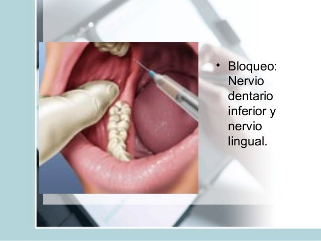 Resultado de imagen para nervio dentario y lingual
