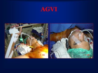 AGVI
 