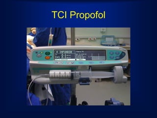 TCI Propofol
 