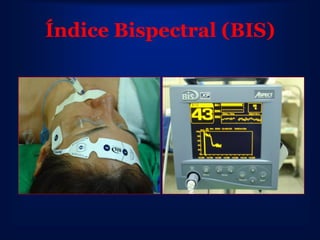 Índice Bispectral (BIS)
 