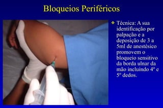 Bloqueios Periféricos
❖ Técnica: A sua
identificação por
palpação e a
deposição de 3 a
5ml de anestésico
promovem o
bloqueio sensitivo
da borda ulnar da
mão incluindo 4º e
5º dedos.
 