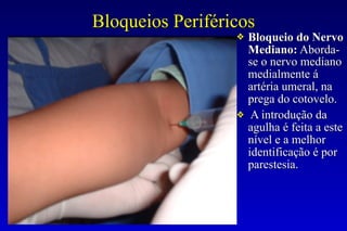 Bloqueios Periféricos
❖ Bloqueio do Nervo
Mediano: Aborda-
se o nervo mediano
medialmente á
artéria umeral, na
prega do cotovelo.
❖ A introdução da
agulha é feita a este
nível e a melhor
identificação é por
parestesia.
 