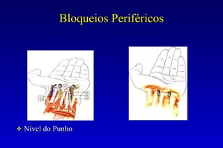 Bloqueios Periféricos
❖ Nível do Punho
 
