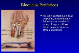 Bloqueios Periféricos
❖ No túnel carpeano, ao nível
do punho, a abordagem é
feita entre os tendões do
palmar longo e o flexor
radial do carpo com 5 a
10ml e anestésico
 