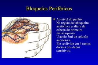 Bloqueios Periféricos
❖ Ao nível do punho:
Na região da tabaqueira
anatômica à altura da
cabeça do primeiro
metacarpiano.
Usando 5ml de solução
anestésica.
Ele se divide em 4 ramos
dorsais dos dedos
sensitivos.
 