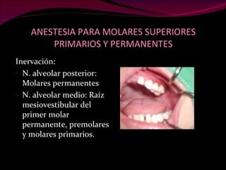 ANESTESIA PARA MOLARES SUPERIORES PRIMARIOS Y PERMANENTES Inervación: N. alveolar posterior: Molares permanentes N. alveolar medio: Raíz mesiovestibular del primer molar permanente, premolares y molares primarios. 
