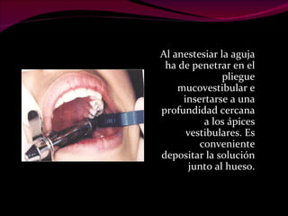 Al anestesiar la aguja ha de penetrar en el pliegue mucovestibular e insertarse a una profundidad cercana a los ápices vestibulares. Es conveniente depositar la solución junto al hueso. 