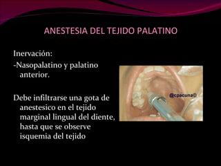 ANESTESIA DEL TEJIDO PALATINO Inervación: -Nasopalatino y palatino anterior. Debe infiltrarse una gota de anestesico en el tejido marginal lingual del diente, hasta que se observe isquemia del tejido 