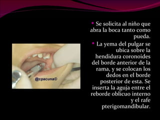 Se solicita al niño que abra la boca tanto como pueda. La yema del pulgar se ubica sobre la hendidura coronoides del borde anterior de la rama, y se colocan los dedos en el borde posterior de esta. Se inserta la aguja entre el reborde oblicuo interno y el rafe pterigomandibular. 