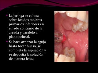 La jeringa se coloca sobre los dos molares primarios inferiores en el lado contrario de la arcada y paralelo al plano oclusal.  Se hace avanzar la aguja hasta tocar hueso, se completa la aspiración y se deposita la solución de manera lenta. 