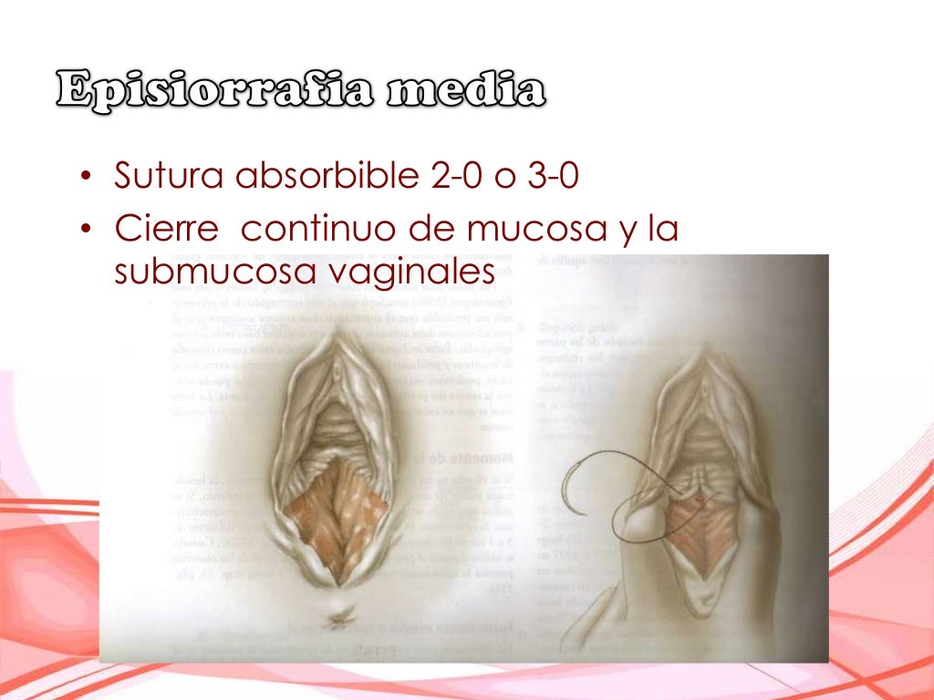 Episiotomia/Episiorrafia