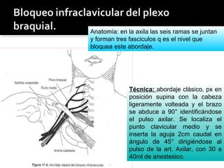 Técnica: abordaje clásico, px en
posición supina con la cabeza
ligeramente volteada y el brazo
se abduce a 90° identificándose
el pulso axilar. Se localiza el
punto clavicular medio y se
inserta la aguja 2cm caudal en
ángulo de 45° dirigiéndose al
pulso de la art. Axilar, con 30 a
40ml de anestesico.
Anatomía: en la axila las seis ramas se juntan
y forman tres fasciculos q es el nivel que
bloquea este abordaje.
 