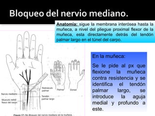 En la muñeca:
Se le pide al px que
flexione la muñeca
contra resistencia y se
identifica el tendón
palmar largo, se
introduce la aguja
medial y profundo a
este.
Anatomía: sigue la membrana interósea hasta la
muñeca, a nivel del pliegue proximal flexor de la
muñeca, esta directamente detrás del tendón
palmar largo en el túnel del carpo.
 
