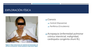 EXPLORACIÓN FÍSICA 
Cianosis 
 Central (Hipoxemia) 
 Periférica (Circulatorio) 
Acropaquia (enfermedad pulmonar 
crónica intersticial, malignidad, 
cardiopatía congénita shunt RL) 
 