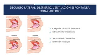 DECUBITO LATERAL, DESPIERTO, VENTILACIÓN ESPONTANEA, 
TORAX ABIERTO 
 A. Regional (Troncular, Neuroaxial) 
 Habitualmente toracoscopia 
 Desplazamiento Mediastinal 
 Ventilación Paradojica 
 