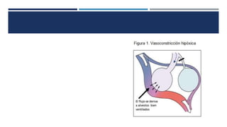 Anestesia para cirugía de tórax