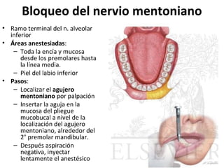 Bloqueo del nervio mentoniano
• Ramo terminal del n. alveolar
  inferior
• Áreas anestesiadas:
   – Toda la encía y mucosa
      desde los premolares hasta
      la línea media.
   – Piel del labio inferior
• Pasos:
   – Localizar el agujero
      mentoniano por palpación
   – Insertar la aguja en la
      mucosa del pliegue
      mucobucal a nivel de la
      localización del agujero
      mentoniano, alrededor del
      2° premolar mandibular.
   – Después aspiración
      negativa, inyectar
      lentamente el anestésico
 