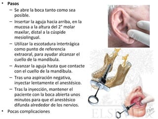 • Pasos
   – Se abre la boca tanto como sea
     posible.
   – Insertar la aguja hacia arriba, en la
     mucosa a la altura del 2° molar
     maxilar, distal a la cúspide
     mesiolingual.
   – Utilizar la escotadura intertrágica
     como punto de referencia
     extraoral, para ayudar alcanzar el
     cuello de la mandíbula.
   – Avanzar la aguja hasta que contacte
     con el cuello de la mandíbula.
   – Tras una aspiración negativa,
     inyectar lentamente el anestésico.
   – Tras la inyección, mantener el
     paciente con la boca abierta unos
     minutos para que el anestésico
     difunda alrededor de los nervios.
• Pocas complicaciones
 