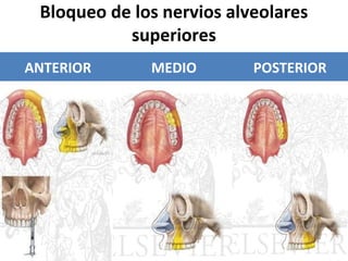 Bloqueo de los nervios alveolares
                   superiores
     ANTERIOR                          MEDIO                    POSTERIOR
Se utiliza con menor           La presencia del nervio se   Bloqueo frecuente
frecuencia por el riesgo de    ha descrito en un 30 % de
lesión al ojo del paciente.    individuos.                  La inyección se realiza en la
                                                            FOSA INFRATEMPORAL
Se anestesia:                  Anestesia todos los
N. alveolar sup anterior       premolares maxilares y la    Anestesia todos los
N. Alveolar superior medio     raíz mesiobul del primer     molares maxilares, con la
N. Infraorbitario              molar.                       posible excepción de la raíz
                                                            mesiobucal del 1° molar
Todos los dientes maxilares Insertar la aguja en el         maxilar, y encía bucal.
desde los incisivos hasta los pliegue mucobucal del 2°
premolares.                   premolar maxilar.             Isertar la aguja en el
                                                            pliegue mucobucal justo
Localizar el agujero                                        superior al 2° molar
infraorbitario por palpación                                maxilar.
 