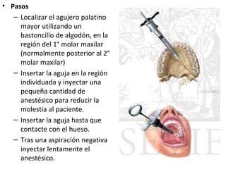 • Pasos
   – Localizar el agujero palatino
     mayor utilizando un
     bastoncillo de algodón, en la
     región del 1° molar maxilar
     (normalmente posterior al 2°
     molar maxilar)
   – Insertar la aguja en la región
     individuada y inyectar una
     pequeña cantidad de
     anestésico para reducir la
     molestia al paciente.
   – Insertar la aguja hasta que
     contacte con el hueso.
   – Tras una aspiración negativa
     inyectar lentamente el
     anestésico.
 