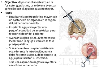 • Objectivo: depositar el anestésico en la
  fosa pterigopalatina, usando una eventual
  conexión con el agujero palatino mayor.
• Pasos
   – Localizar el agujero palatino mayor con
     un bastoncillo de algodón en la región
     del primer molar maxilar.
   – Insertar la aguja y inyectar una
     pequeña cantidad de anestésico, para
     reducir el dolor del paciente.
   – Avanzar la aguja de 28-30 mm: en esa
     localización la aguja estará en la fosa
     pterigopalatina.
   – Si se encuentra cualquier resistencia
     ósea durante la introdución, nunca
     debe forzarse la aguja, debe rotarse la
     aguja para facilitar su inserción.
   – Tras una aspiración negativa inyectar el
     anestésico lentamente.
 