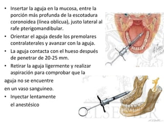 • Insertar la aguja en la mucosa, entre la
  porción más profunda de la escotadura
  coronoidea (línea oblicua), justo lateral al
  rafe pterigomandibular.
• Orientar el aguja desde los premolares
  contralaterales y avanzar con la aguja.
• La aguja contacta con el hueso después
  de penetrar de 20-25 mm.
• Retirar la aguja ligermente y realizar
  aspiración para comprobar que la
aguja no se encuentre
en un vaso sanguineo.
• Inyectar lentamente
  el anestésico
 