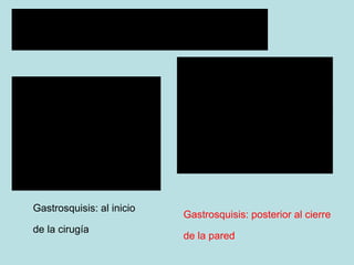 Gastrosquisis: al inicio de la cirug ía Gastrosquisis: posterior al cierre de la pared 
