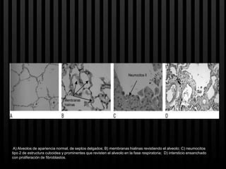 A) Alveolos de apariencia normal, de septos delgados; B) membranas hialinas revistiendo el alveolo; C) neumocitos
tipo 2 de estructura cuboidea y prominentes que revisten el alveolo en la fase respiratoria; D) intersticio ensanchado
con proliferación de fibroblastos.
 