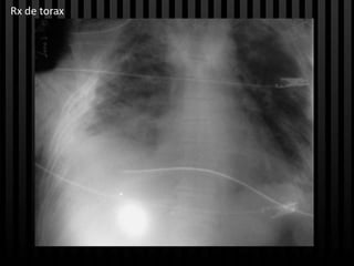 Rx de torax
 