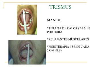 TRISMUS MANEJO * TERAPIA DE CALOR ( 20 MIN POR HORA * RELAJANTES MUSCULARES * FISIOTERAPIA ( 5 MIN CADA 3 O 4 HRS)  