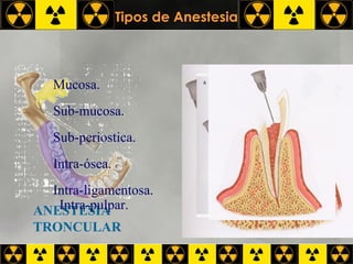 Tipos de Anestesia ANESTESIA  TRONCULAR Mucosa. Sub-mucosa. Sub-periostica. Intra-ósea. Intra-ligamentosa. Intra-pulpar. 