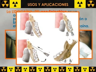 USOS Y APLICACIONES La LIDOCAÍNA  2%   con Epinefrina   es un anestésico local indicado en procedimientos dentales de infiltración o bloqueo nervioso donde se requiere efectos mas prolongados de la Lidocaína.   