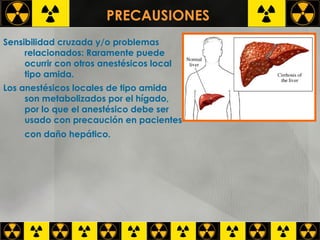 PRECAUSIONES  Sensibilidad cruzada y/o problemas relacionados: Raramente puede ocurrir con otros anestésicos local tipo amida.  Los anestésicos locales de tipo amida son metabolizados por el hígado, por lo que el anestésico debe ser usado con precaución en pacientes con daño hepático.     