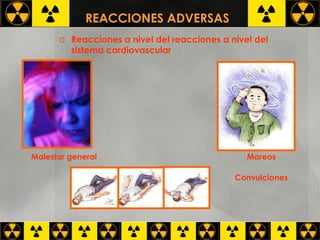 REACCIONES ADVERSAS   Reacciones a nivel del reacciones a nivel del sistema cardiovascular  Mareos Convulciones Malestar general 