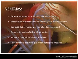 VENTAJAS:
 • Paciente permanece consiente y capaz de colaborar.

 • Existe una distorsión mínima de la fisiología normal del paciente.

 • Su morbilidad es mínima y su mortalidad es excepcional.

 • Comprende técnicas fáciles. Menor costo.

 • Reduce el sangrado en el área a intervenir.

 • Se administra a pacientes que no son aptos para anestesia
   general.




                                                        CD. MARCOS NOVOA HERRER
 