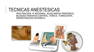TECNICAS ANESTESICAS
INFILTRACION, IV REGIONAL, BLOQ NERVIO PERIFERICO,
BLOQUEO NERVIOSO CENTRAL, TOPICA, TUMESCENTE,
DMINISTRACION SISTEMICA.
 
