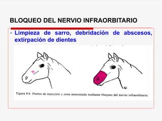 BLOQUEO DEL NERVIO INFRAORBITARIO
 Limpieza de sarro, debridación de abscesos,
extirpación de dientes
 