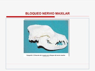 BLOQUEO NERVIO MAXILAR
 