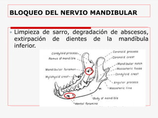 BLOQUEO DEL NERVIO MANDIBULAR
 Limpieza de sarro, degradación de abscesos,
extirpación de dientes de la mandíbula
inferior.
 