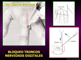 ANESTESICOS LOCALES TIPOS Y TECNICAS. Prfo. Dr. Luis del Rio Diez Slide 28