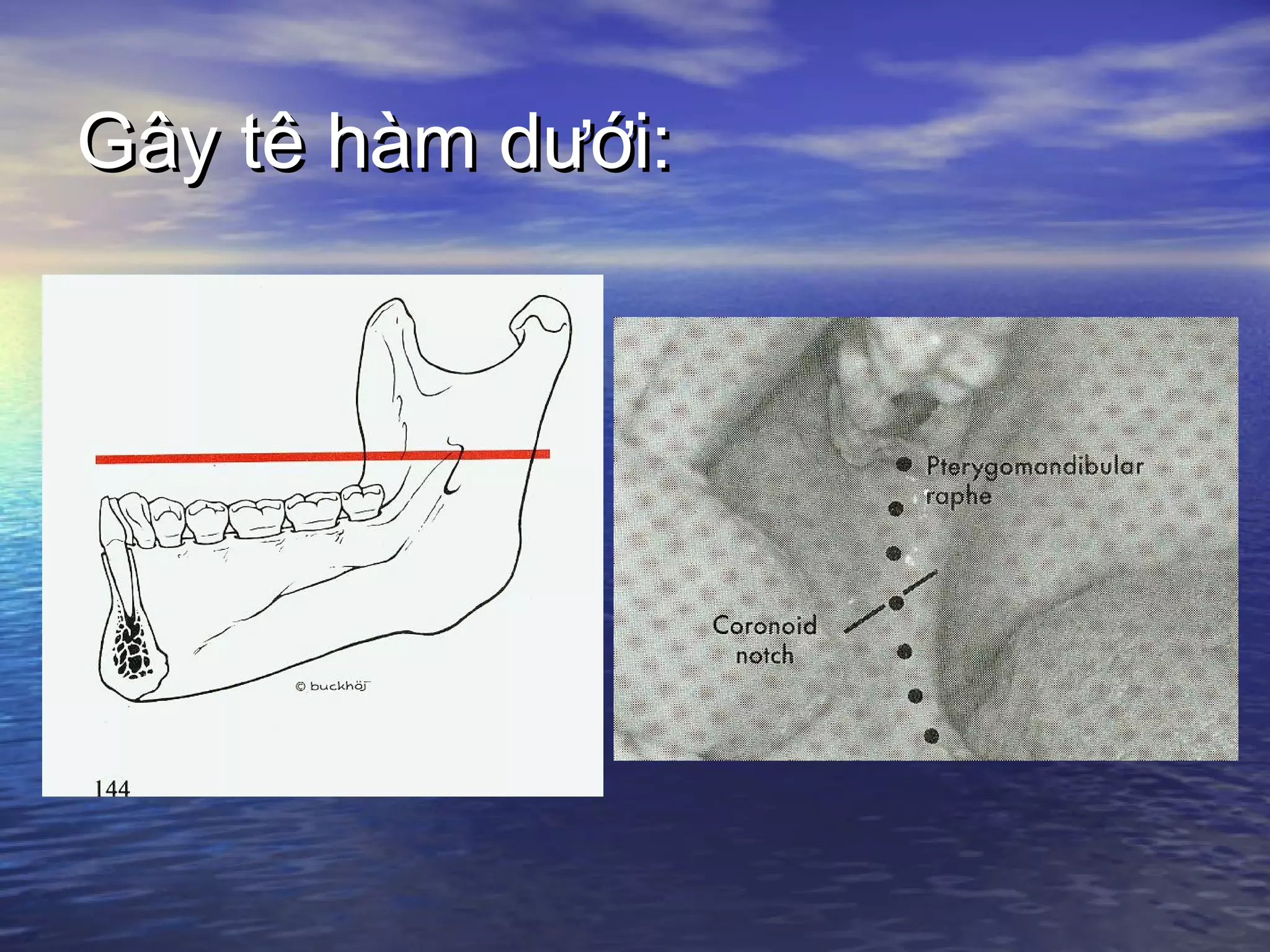 Gây tê hàm dưới:Gây tê hàm dưới:
 