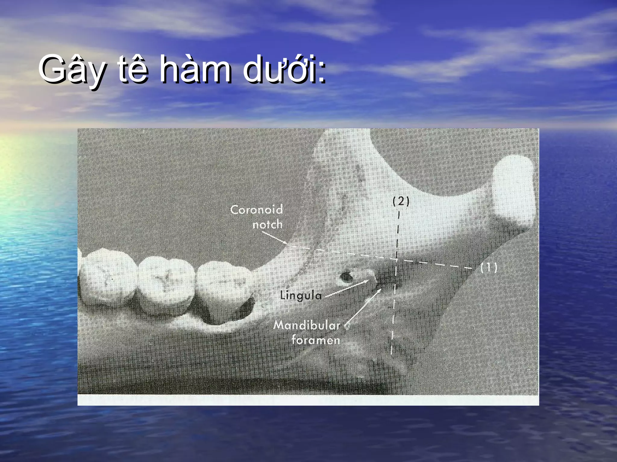 Gây tê hàm dưới:Gây tê hàm dưới:
 