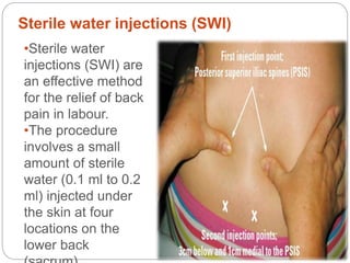 Sterile water injections (SWI)
•Sterile water
injections (SWI) are
an effective method
for the relief of back
pain in labour.
•The procedure
involves a small
amount of sterile
water (0.1 ml to 0.2
ml) injected under
the skin at four
locations on the
lower back
 