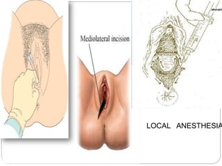 LOCAL ANESTHESIA
 
