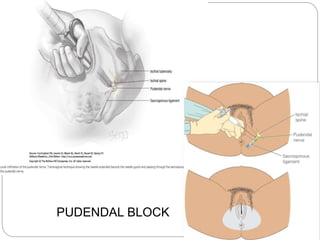PUDENDAL BLOCK
 