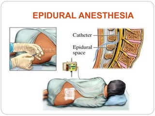 EPIDURAL ANESTHESIA
 
