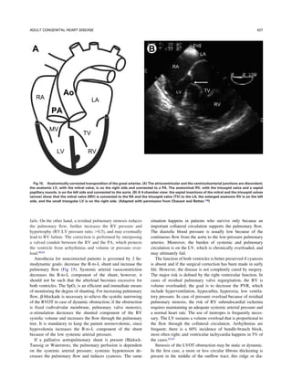 Anesthesia And Congenital Heart Disease | PDF